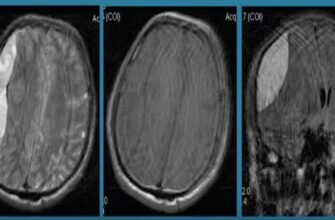 Субдуральна гематома: наслідки та ризики для здоров’я головного мозку