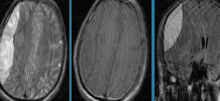 Субдуральна гематома: наслідки, діагностика та лікування