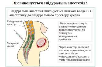 Епідуральна анестезія: наслідки та ризики для здоров’я пацієнтів
