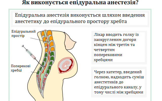 Епідуральна анестезія: наслідки та ризики для здоров’я пацієнтів