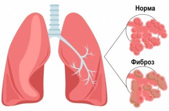 Чи можна вилікувати фіброз легень: сучасні методи та підходи