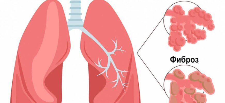 Чи можна вилікувати фіброз легень: сучасні методи та підходи