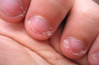 Гризти нігті: наслідки для здоров’я, про які варто знати