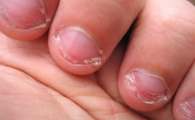 Гризти нігті: наслідки для здоров’я, про які варто знати