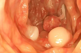 Чи можна завагітніти після видалення поліпа: відновлення шансів на вагітність