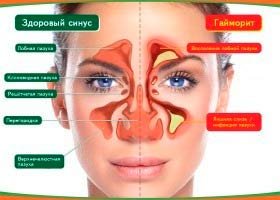Чи можна гріти гайморит: поради та застереження від лікарів