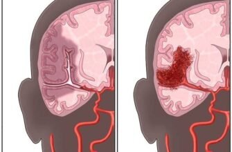 Крововилив у мозок: наслідки та шляхи відновлення здоров’я