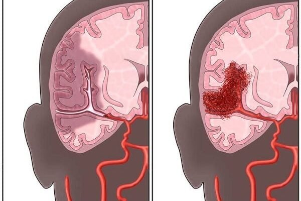 Крововилив у мозок: наслідки та шляхи відновлення здоров’я