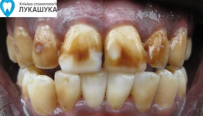 Гнилі зуби: наслідки занедбаної гігієни для вашого здоров’я