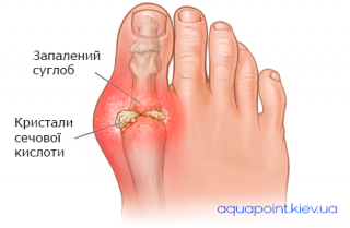 Чи можна парити ноги при подагрі: основні рекомендації та застереження