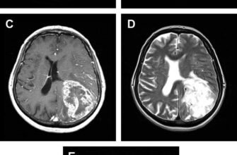 Набряк головного мозку: наслідки, про які потрібно знати кожному