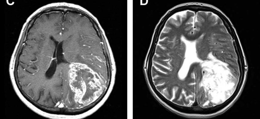 Набряк головного мозку: наслідки, про які потрібно знати кожному