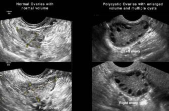 “Мультифолікулярні яєчники: наслідки, ризики та шляхи вирішення”