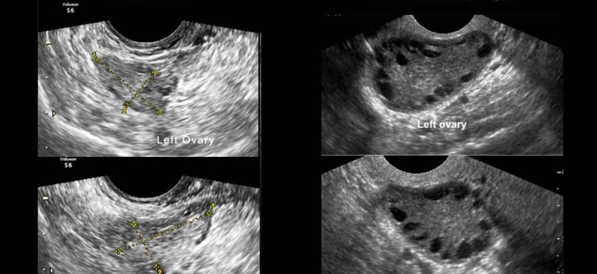 “Мультифолікулярні яєчники: наслідки, ризики та шляхи вирішення”