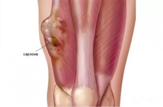 Чи можна вилікувати саркому? Методи лікування та їх ефективність