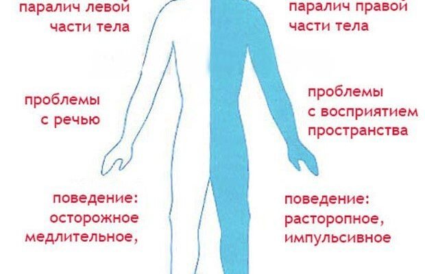Наслідки ішемічного інсульту МКХ 10: вплив та відновлення після хвороби
