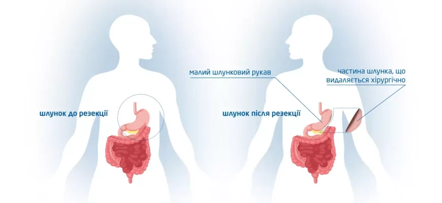 Чи можна вилікувати рак шлунка: сучасні підходи та методики лікування