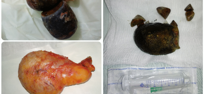 Обговорення на форумі: Наслідки видалення жовчного міхура