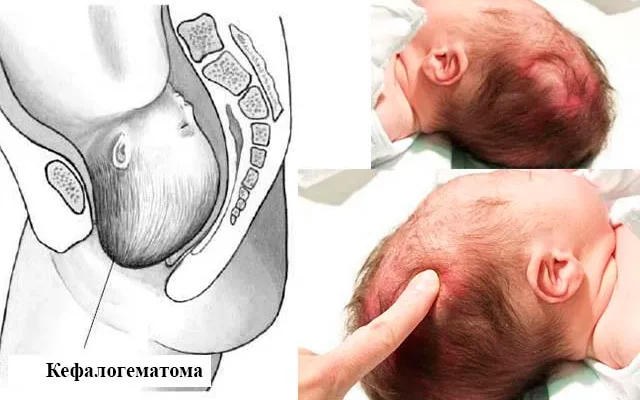Кефалогематома: наслідки та важливість ранньої діагностики