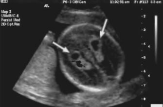 Кіста судинного сплетення у плода: можливі наслідки та ризики