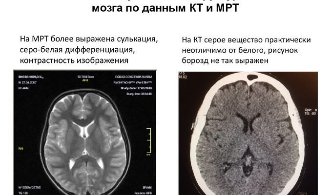 МРТ та КТ: Яка різниця? Вибір найкращого методу діагностики