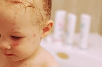 Чи можна купатися при вітрянці: поради лікарів та обмеження