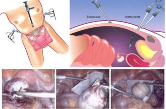 Наслідки після видалення яєчників: що очікувати та як адаптуватися