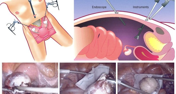 Наслідки після видалення кісти яєчника: що варто знати пацієнтам