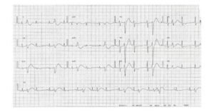 Чи можна вилікувати екстрасистоли: ефективні методи та рекомендації
