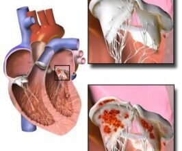 Чи можна вилікувати інфекційний ендокардит: ефективні методи лікування