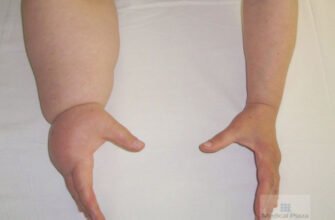 Наслідки з видалення пахвових лімфовузлів: що варто знати?