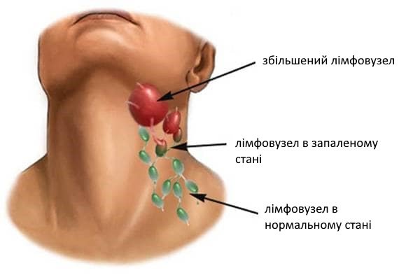Чи можна видаляти лімфовузли: ризики, наслідки та протипоказання Чи можна видаляти лімфовузли: ризики, наслідки та протипоказання