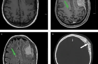 Наслідки після видалення менінгіоми: що варто знати для відновлення