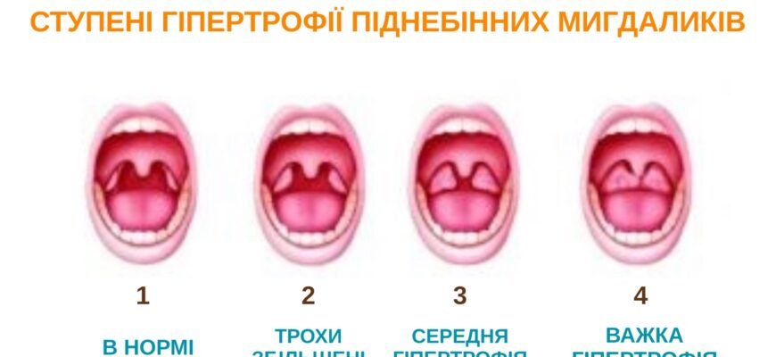 Видалення мигдаликів: наслідки та важливі аспекти процедури