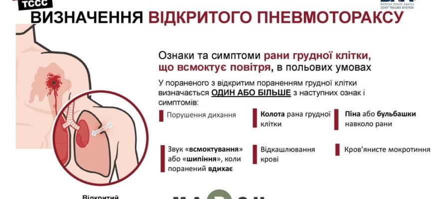 Закритий пневмоторакс: невідкладна допомога та практичні поради