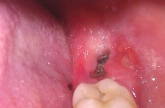 Наслідки після видалення 8 зуба: що очікувати після процедури