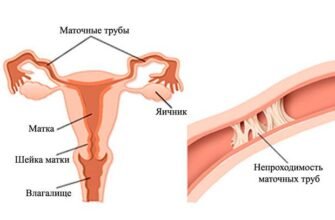 Наслідки видалення маткової труби: що варто знати про здоров’я