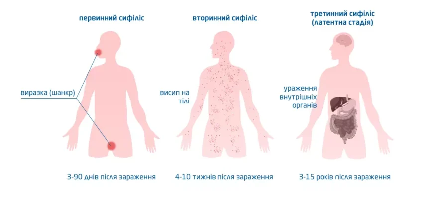 Сифіліс: наслідки та ускладнення, про які варто знати всім