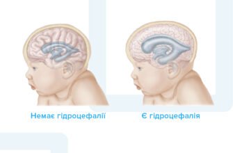 Чи можна вилікувати гідроцефалію: сучасні методи та перспективи лікування