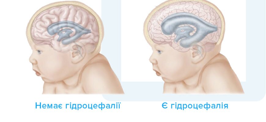 Чи можна вилікувати гідроцефалію: сучасні методи та перспективи лікування