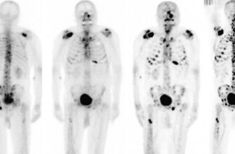 Чи можна зупинити метастази в кістках: шляхи і можливості лікування