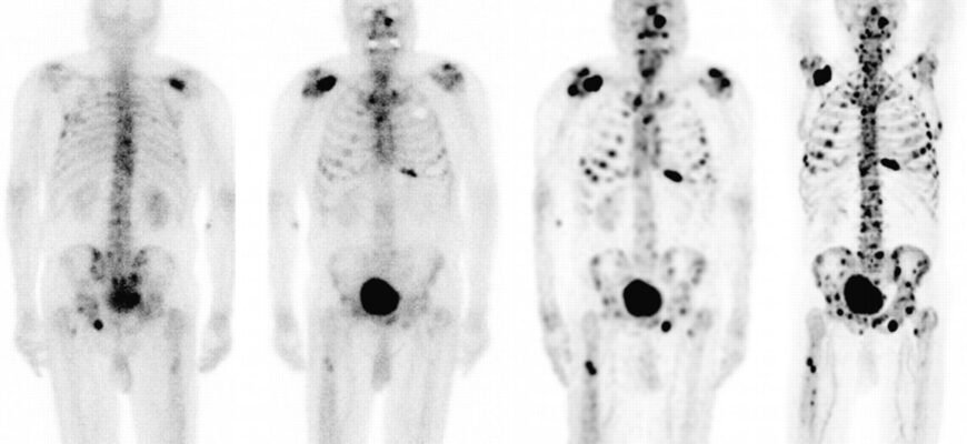 Чи можна зупинити метастази в кістках: шляхи і можливості лікування
