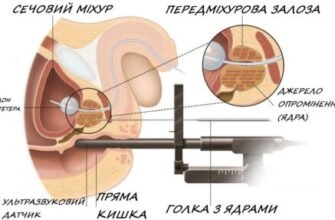 Променева терапія: наслідки та вплив на організм після лікування