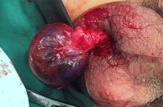 Перекрут яєчка: наслідки, про які варто знати кожному чоловікові