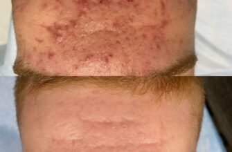 Системні ретиноїди: наслідки та їх вплив на організм людини