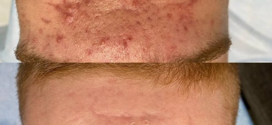 Системні ретиноїди: наслідки та їх вплив на організм людини