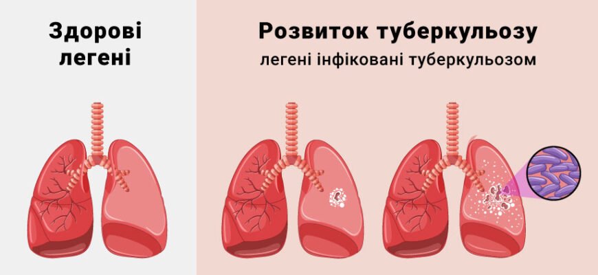 Чи можна вилікувати туберкульоз: сучасні методи та підходи в терапії
