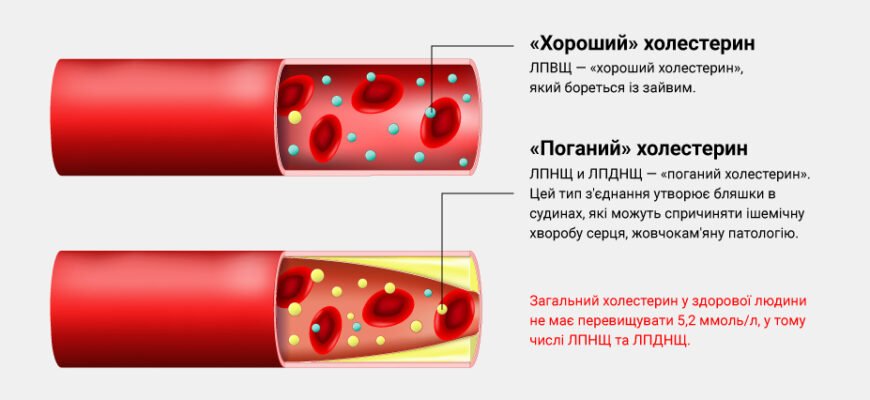 Високий холестерин: наслідки та як знизити ризик захворювань