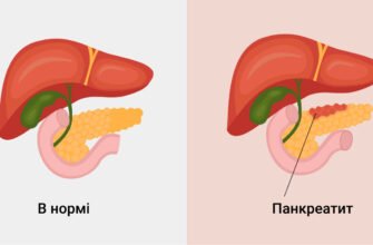 Чи можна вилікувати хронічний панкреатит: факти та поради лікарів