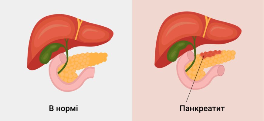 Чи можна вилікувати хронічний панкреатит: факти та поради лікарів